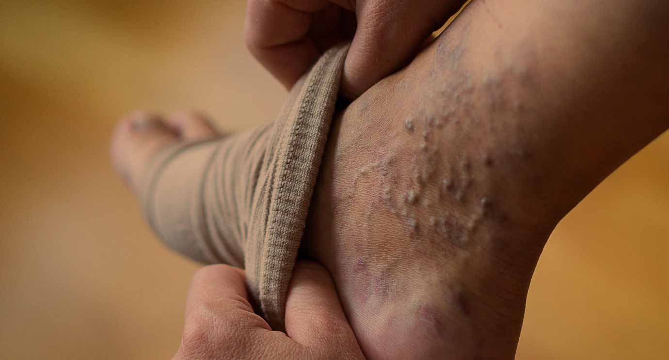 varicose_vein_appearance